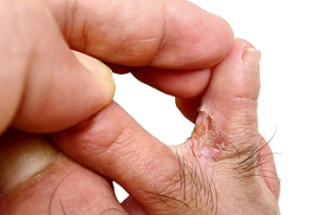 Corns Can Develop on Multiple Parts of the Foot