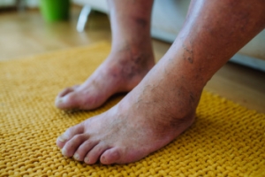 Protecting Your Feet if You Have Diabetes