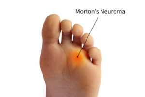 Understanding Morton&#039;s Neuroma