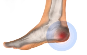 Uncomfortable Heel Pain and Plantar Fasciitis